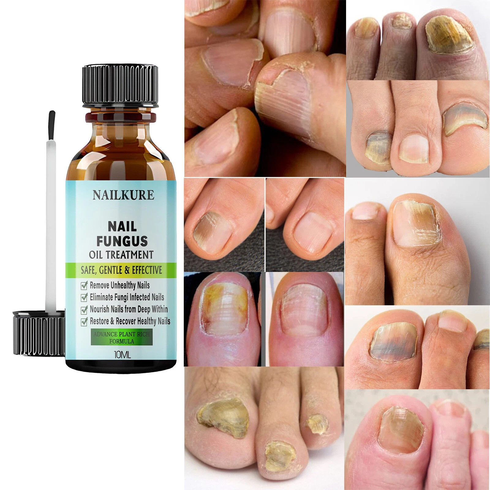 Nail Fungal Treatment Anti Fungus Infection Fungal Toe Nails Infection Care UK