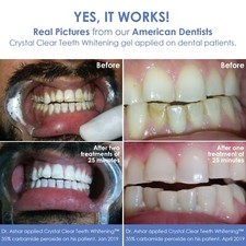 Kit de Gel Blanqueador de Dientes Crystal Clear con luz LED