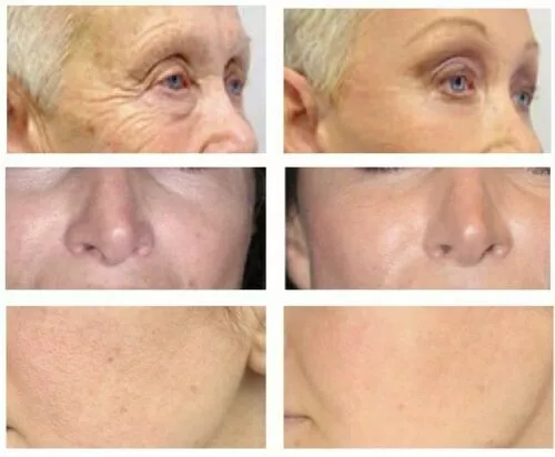 Retinol, Niacinamide B3, Vitamin C, Hyaluronic Acid, Anti-Aging Wrinkle SERUM - Picture 4 of 4