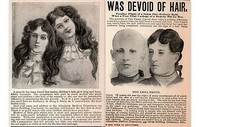 2 Late 1890 's  Altenheim Medical Emma Emond Bald Quack Young Girls Print Ads