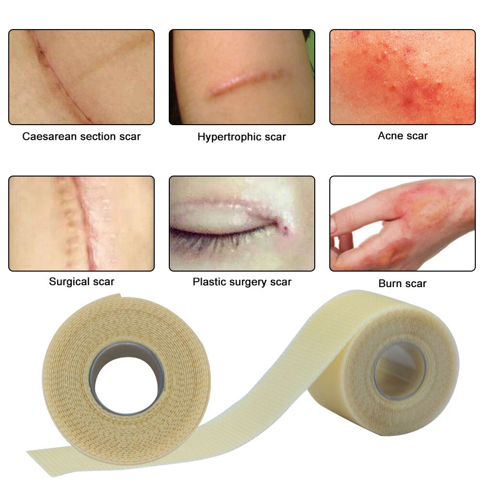 Silicone Scar Sheets (1.6 X 120), Medical Silicone Scar Tape Roll, Strips,  Patch, Bandage - Scars Removal Treatment - Keloid Scar Silicone Sheets for