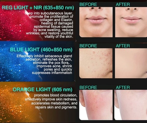 LED Red/Blue/Amber/NiR Professional 72mw/cm Light Therapy Silicone Mask 372 LEDS - Picture 5 of 5