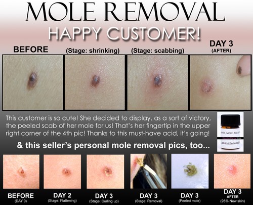 11 Before and After pics Remove Skin Tag, Wart, Mole, Keloid Remover