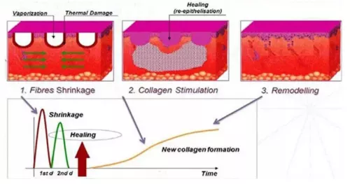 CO2 fraktionierte Laser Haut Resurfacing Maschine Dehnungsstreifen Entfernung Aknenarbe - Bild 8 von 19