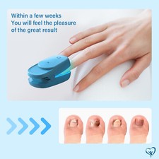 Nail Fungus Laser-Device Anti-Fungal Device Fingernail Toenail Repair Remover