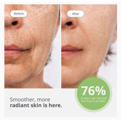 Authentic Tria Age Defying / Smooth Beauty Laser, FDA cleared - No