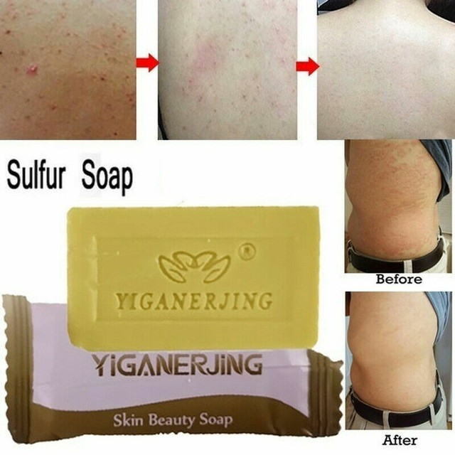 sulfur for acne
