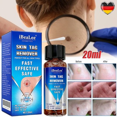 Warzenentferner, 20 ml Hühneraugen Entferner, extra starker Warzen Entfernen HOT