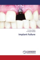 Vishnu Maske (U. A.) | Implant Failure | Taschenbuch | Englisch (2021)