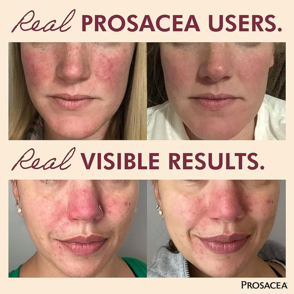 Prosacea GEL Rosacea Treatment Homeopathic Gel Sulphur - Image 3 of 4