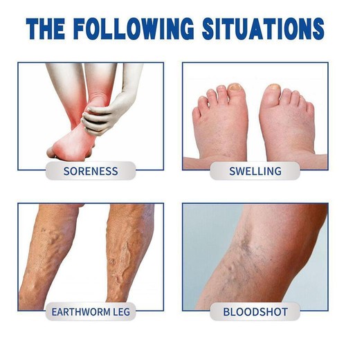 Vein Removal Cremevital Varicose Cream Vein Ease Paste,Improve Circul N2H4 C4X1 - Picture 10 of 15