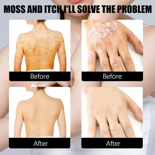 30ml Skin Psoriasis Spray Natural Herb Eczema Treatment Spray Itch Relief New - Picture 7 of 19