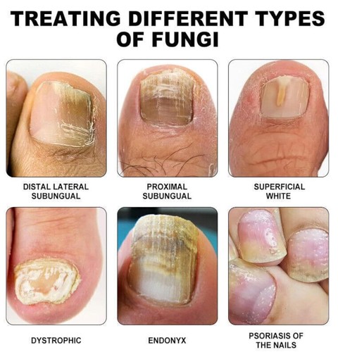 Dispositivo di terapia laser funghi unghie puri dispositivo terapia della luce unghie fungine portatile - Foto 7 di 8