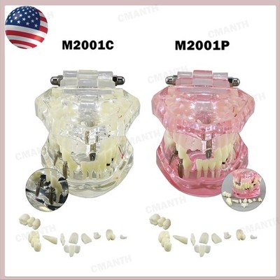 US Dental Teeth Implant Restoration Model Transparent Pathological Study Demo