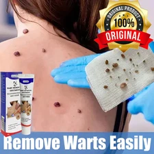 100% Skin Tag Mole Wart Removal (ORIGINAL) 20G