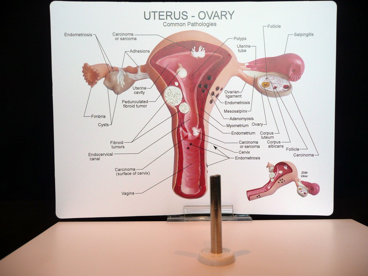 Uterus And Ovary Anatomy Model With Pathologies Ebay Anatomical