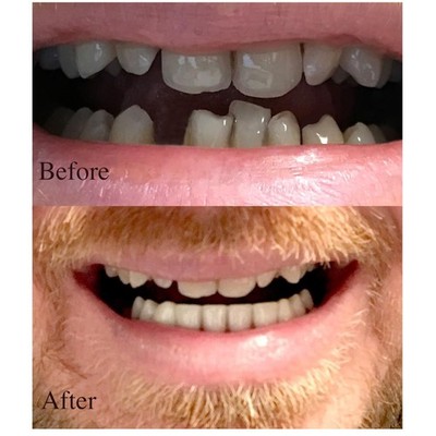 Handcrafted Cosmetic Lower Teeth - Custom Fit at Home!