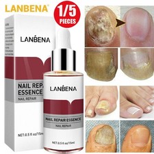 5/3PCS Nail Repair Essence Remove Onychomycosis Serum Fungal Nail Treatment Oil