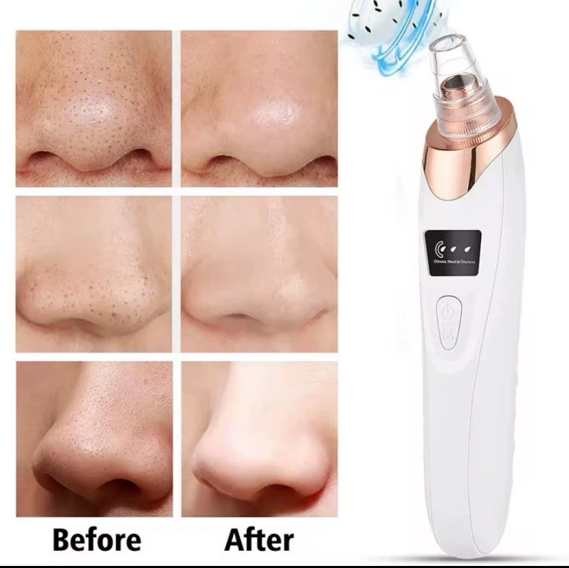 Electric Pore Cleaner - Blackhead Remover with Vacuum Cleaner + Attachments - Image 2 of 4