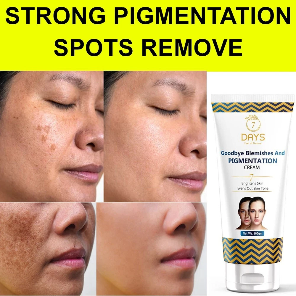Pigmentation removal cream deals