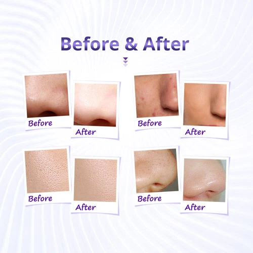 Face Beauty Spray Beauty Skin Rejuvenation Diamond Peeling Dermabrasion Machine - Picture 5 of 10