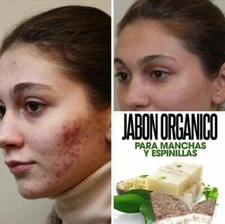Jacvonwhitefadesoap: Para combatir el acne, hongo, picason, en la Cara o Cuerpo.