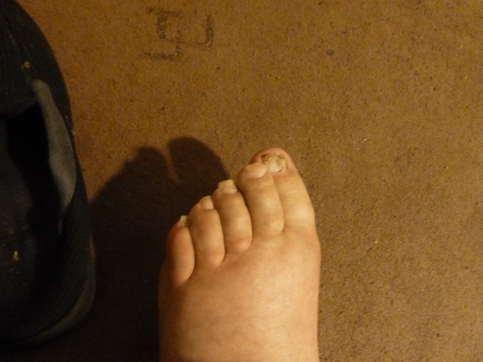 FUNGAL NAIL TREATMENT Lotion KILLS 99.9 of Nail Fungus feet toes hands