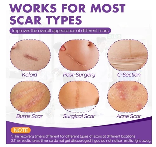 Silicone Scar Sheets & Tape Roll (3M) | Scar Removal, Keloid,Surgery, Acne,Marks - Picture 2 of 4