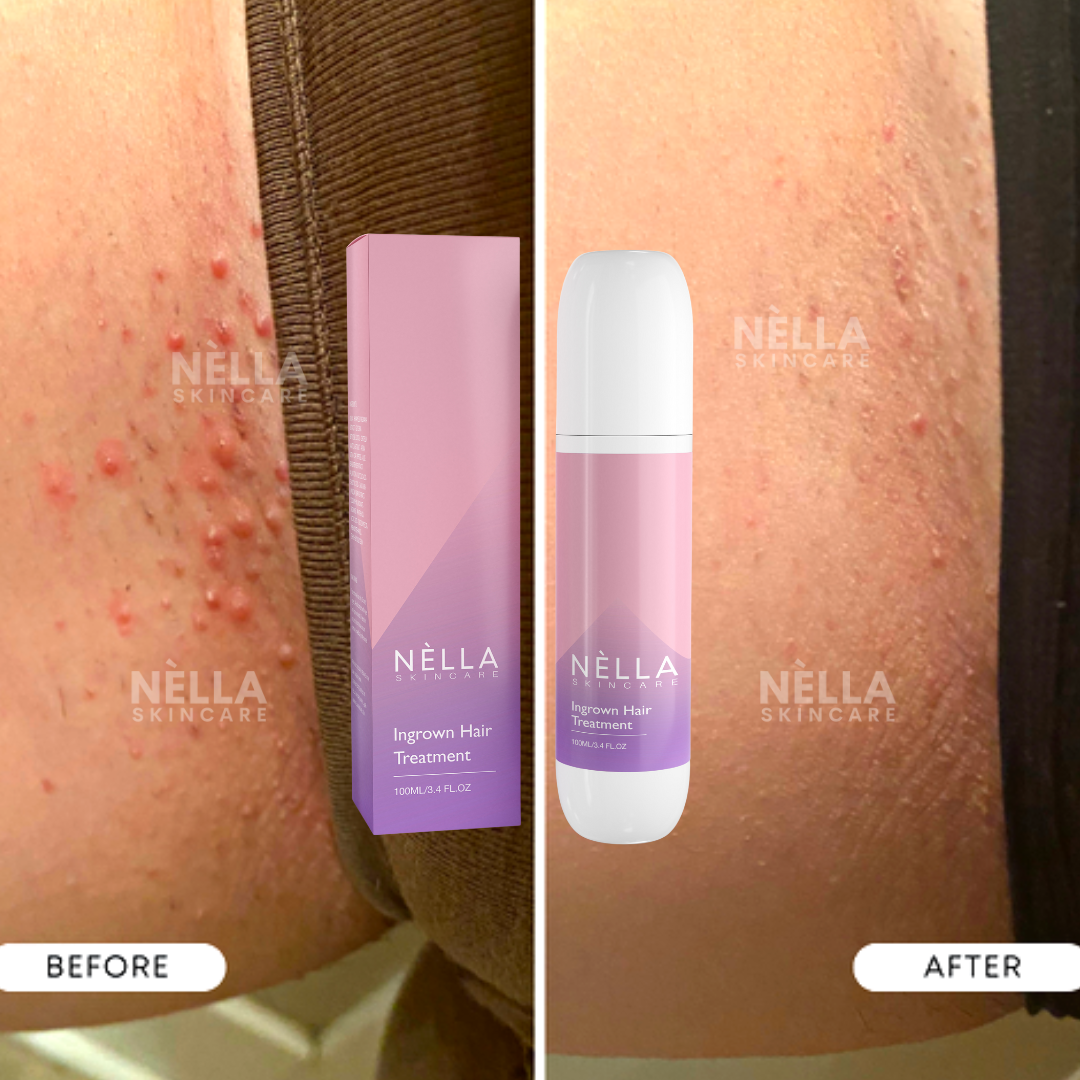 Depilación Láser Como Depilarse El Pubis Sin Que Salgan Granitos