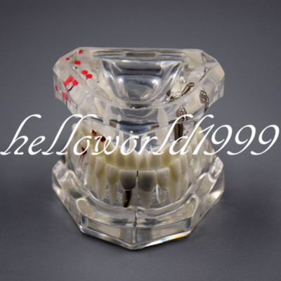 Implant Teeth With Restoration Bridge Tooth Dentist Disease Teaching Implant Teeth With Restoration Bridge Tooth Dentist Disease Teaching