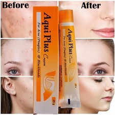 Natural Cream for Pimples, Blemishes  Acne Marks - 25gm