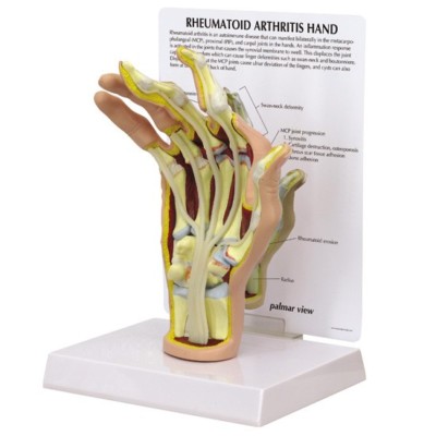 Hand Rheumatoid Arthritis GPI Anat Model LFA #1931. Make Us an Offer! SEE VIDEO