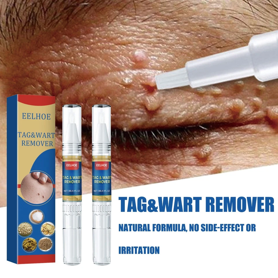Skin Tag Removal Pen Wart Remover Kit,Effective Treatment of Warts, Corns Spot M - image 3 of 4
