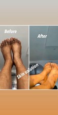 Dark Spot Remover for Face Body Fade Acne Marks,etc..