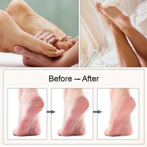 Electric Foot Grinder Care Pedicure Foot File Hard Dead Skin Callus Remover OZ - Picture 3 of 11