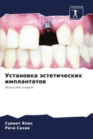 Sumeet Yalan (U. A.) | Ustanowka äSteticheskih Implantatow | Taschenbuch (2022)