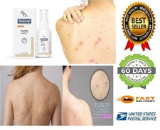 2 Salicylic Acid Salyzap Body Acne Spray 50ml for Acne on Body