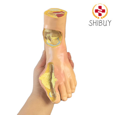 Diabetes Target  Model Pain Wind Stone Foot Complication Model