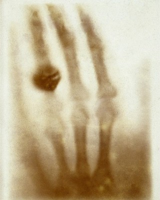 Firs Medical X-Ray by Wilhelm Röntgen 8x10 Photograph Print 8''x10''