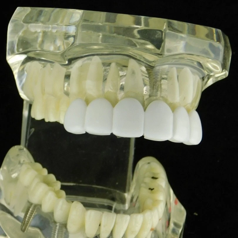 Men's White Teeth Grillz Top 6 Teeth Bright Smile Pre-Made Instant Mouth Grills - Image 3 of 4