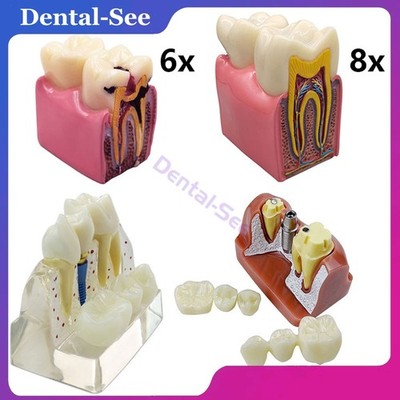 Dental Implant Analysis Crown Bridge 6/8x Magnified Caries Contrast Tooth Model