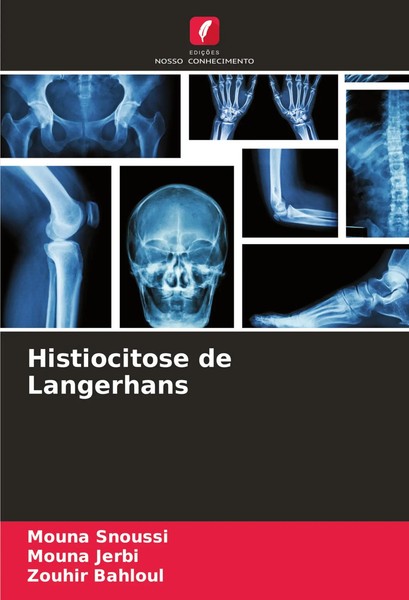 Mouna Snoussi (U. A.) | Histiocitose De Langerhans | Taschenbuch | Portugiesisch-image