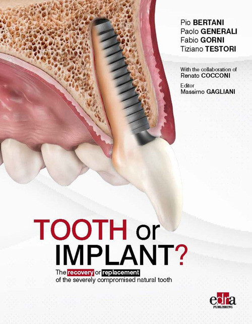 Tooth Or Implant? The Recovery Or Replacement Of The Severely Compormised Natura