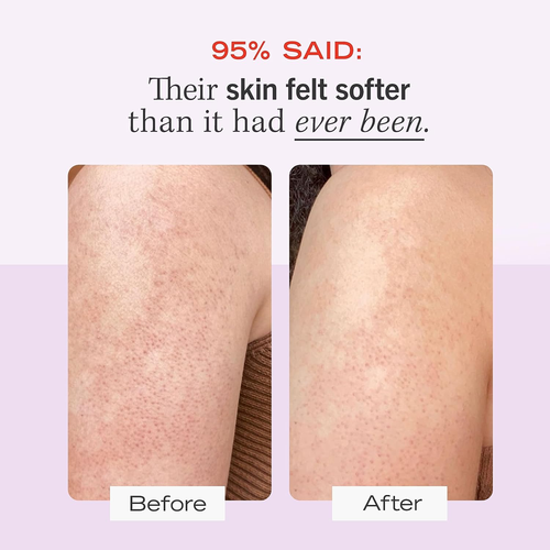 First Aid Beauty - KP Bump Eraser Body Scrub with 10% AHA, Keratosis Pilaris Ski - Picture 3 of 12