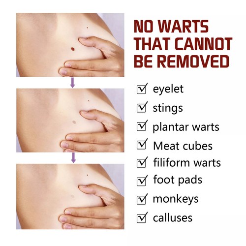 Common and Plantar Moles-Off Wartsoff Remover, WipeOff Tags&Moles Remover USA - Bild 10 von 19
