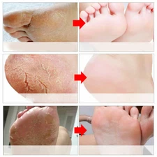 Exfoliating Foot Peeling Mask Feet Peel Mask Sheds Skin Calluses Feet USA SELLER