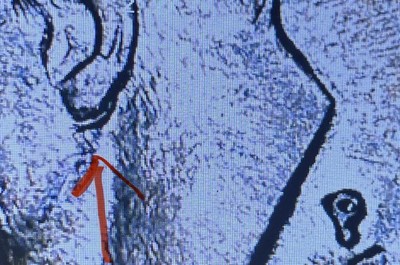   1987 P Roosevelt Dime DDO Double Ear,  Plus Cracks, Abrasions ERROR SEE 