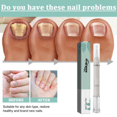 Anti Fungal Nail Treatment Repair Finger Toe Care Nail Fungus Liquid Pen