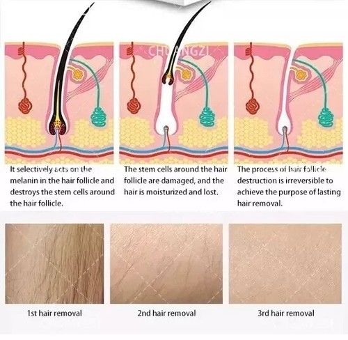 2025 Ice Titanium Soprano Permanent Painless Diode Laser hair removal Machine - Picture 21 of 24