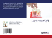 Avinash Kumar | ALL ON Four Implants | Taschenbuch | Englisch (2024)